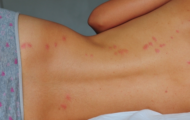 picture of woman's body and skin with bed bug bites